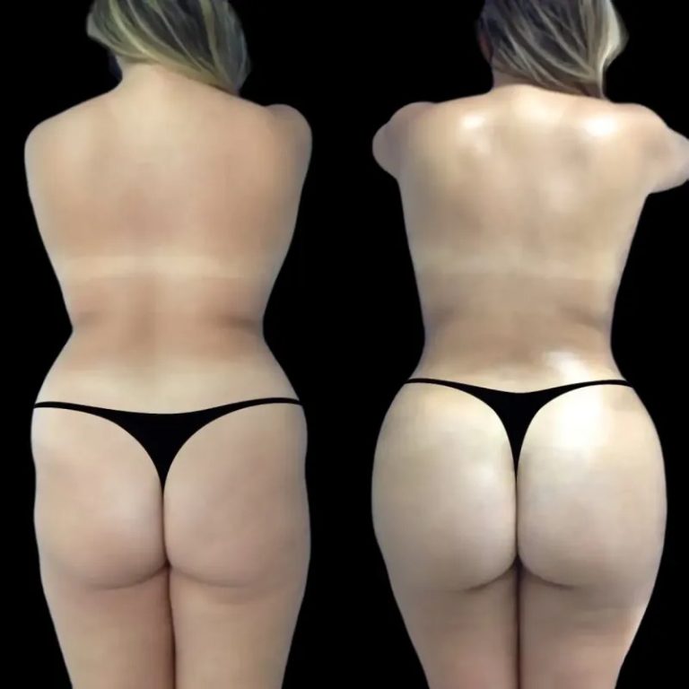 Combining Buttock Fat Transfer with Liposuction: A Complete Guide