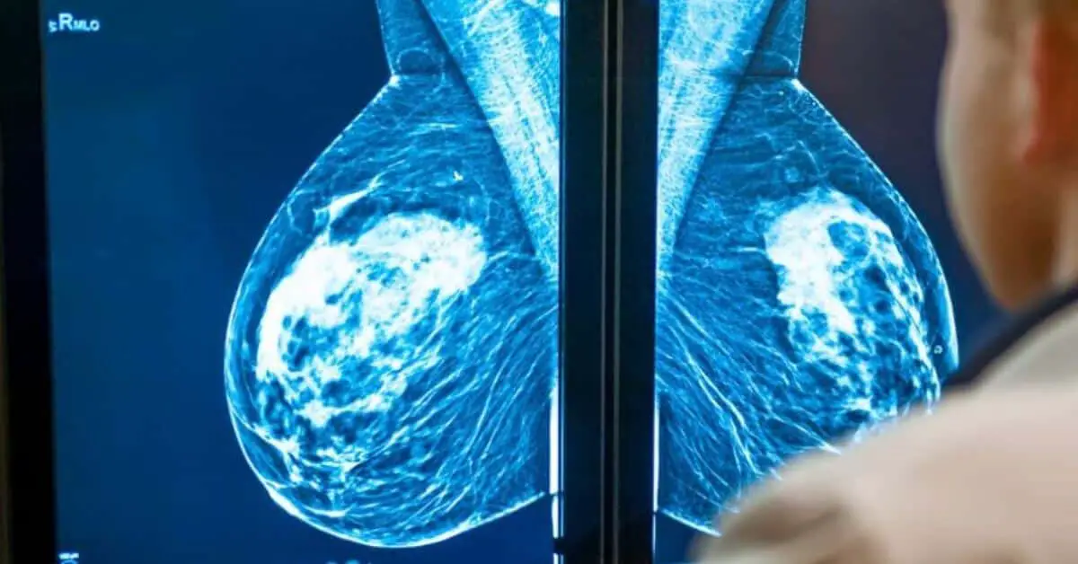 Mammogram (1)