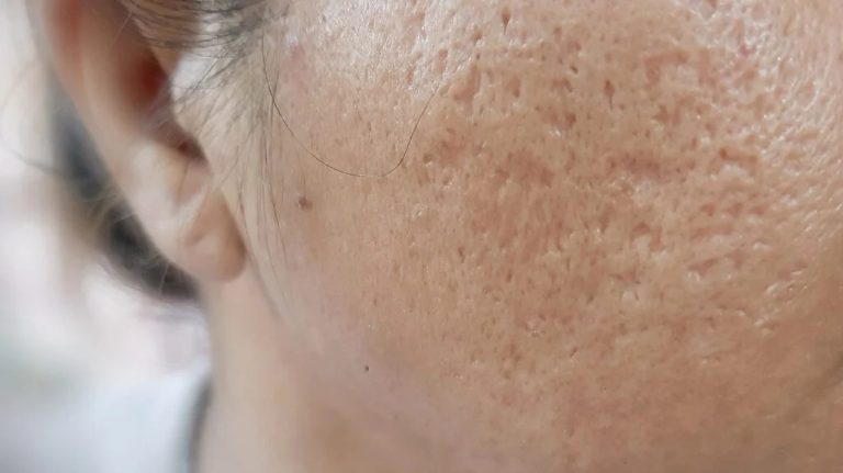 Transform Your Complexion: Fractional CO2 Laser Therapy for Acne Scars