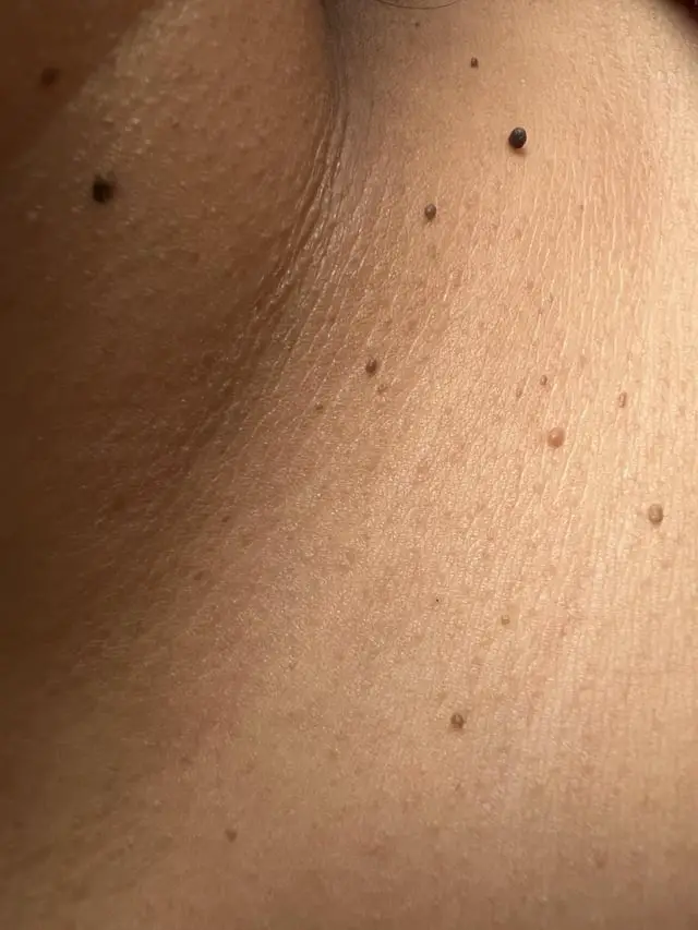 skin tag 2