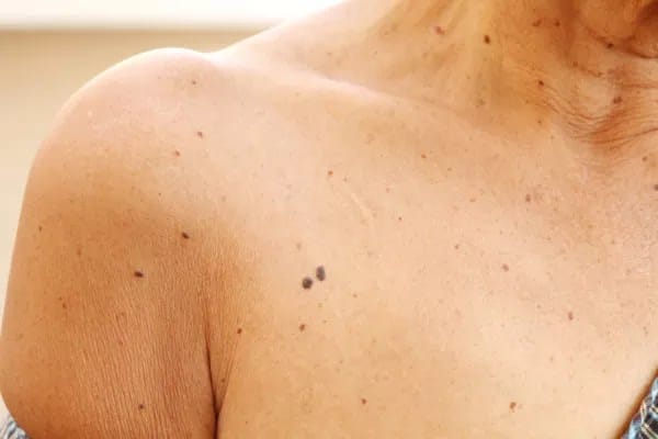 Skin Tag Removal for Sensitive Skin in Dubai