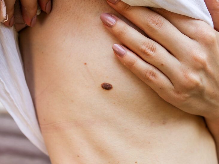 Why Is Skin Tag Removal Necessary?