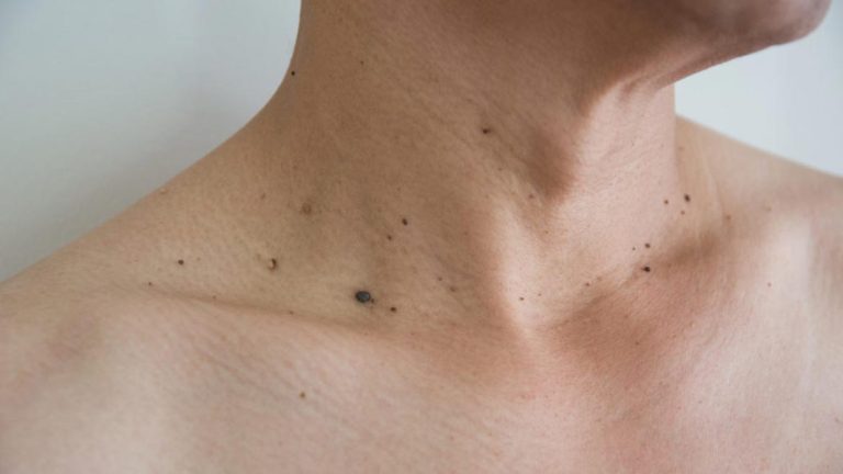 Get Rid of Neck Skin Tags: Safe and Effective Removal Methods