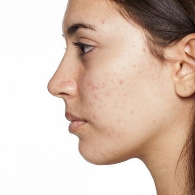 Blemish-Free Beauty: 10 Unparalleled Acne Scar Treatments