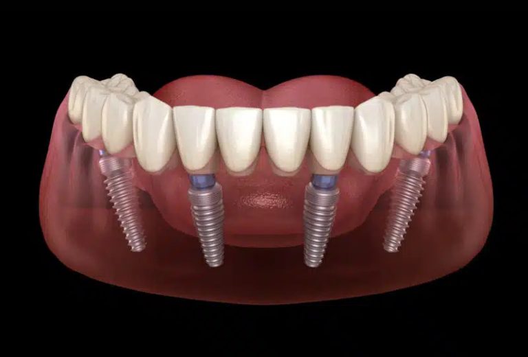 Unveiling the Price Tag: Demystifying Full Mouth Dental Implants