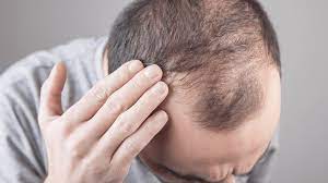 Dubai Hair Transplants: How Much Does it Cost to Regain a Youthful Appearance?