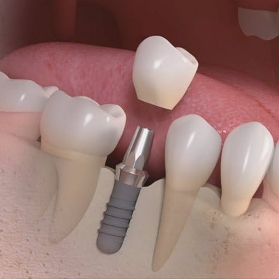 What Factors Determine Single Tooth Implant Cost in Dubai?