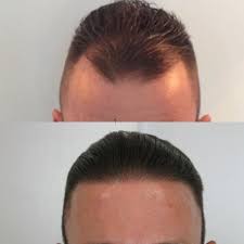 Can you get a small hair transplant?