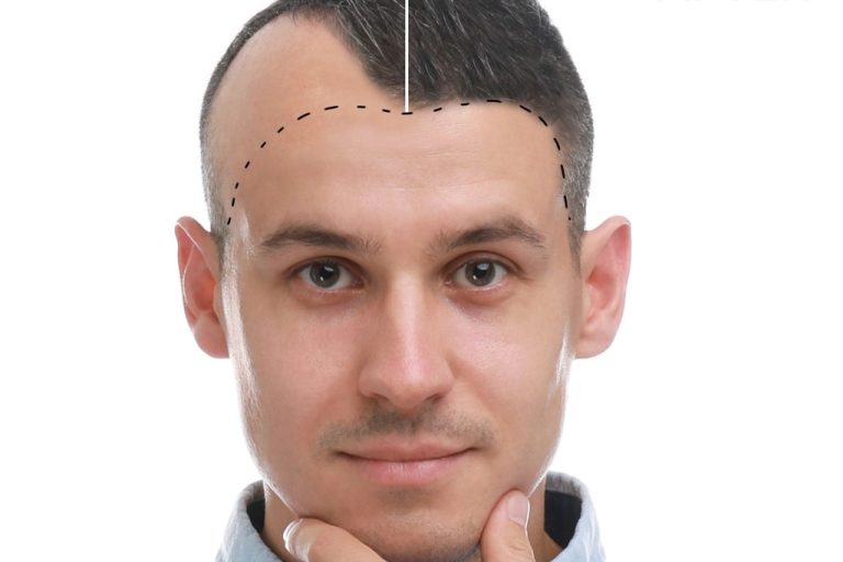 Baldness and Hair Transplant Surgery: A Myth or Fact?