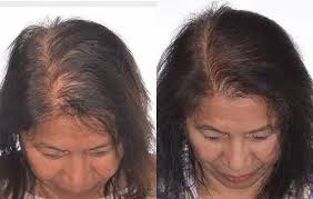 How to Use Laser Hair Therapy for Hair Loss