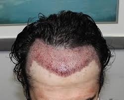 Is there any disadvantages of hair transplant?