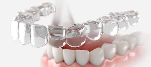 Clear Aligners Market Trends: Size, Share, and Growth Forecast