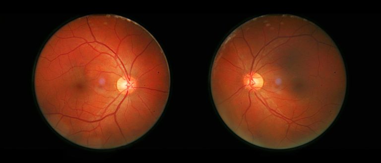 Exploring Retinal Disease Therapeutics Market Size, Share, and Latest Trends