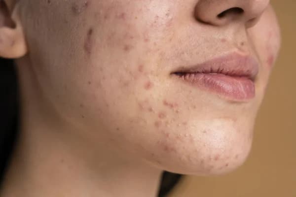 9 Common Myths Debunked About Acne Treatment