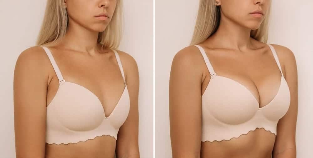 Breast Augmentation in Dubai 10