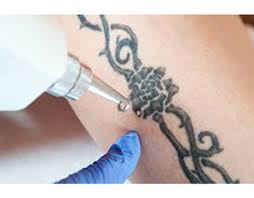 Fresh Looks, Fresh Skin: Laser Tattoo Removal Services in Dubai