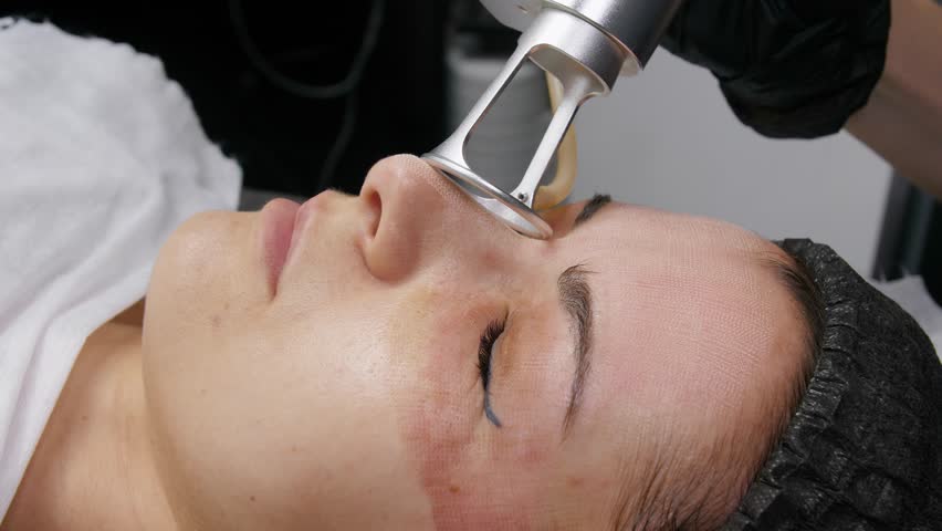 Fractional CO2 laser treatment in Dubai