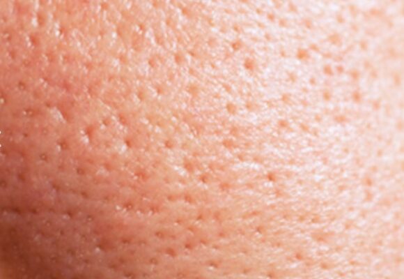 Everything One Needs To Know About Open Pores