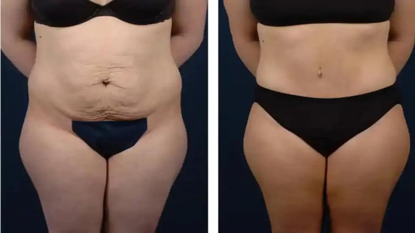 Tummy-Tuck-Before-After-Photos ( (4)