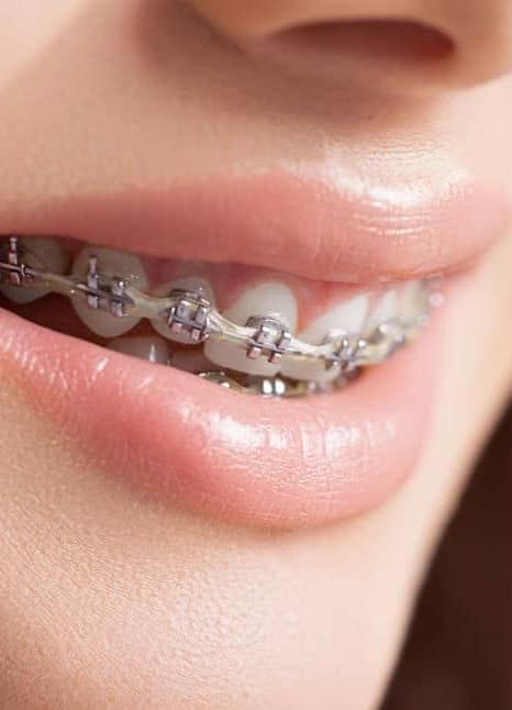 Exploring the Price Range of Braces in Dubai