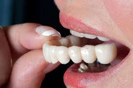 Teeth Crowns in Dubai: Your Best Choice