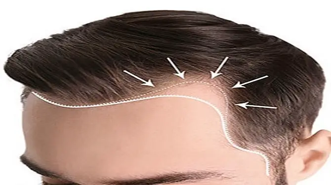 How Does FUE Hair Transplant Work in Dubai?