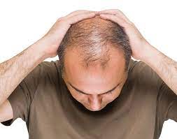 Natural Remedies to Combat Hair Loss & Hair transplant in Dubai UAE