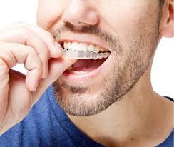 Invisalign Braces Treatment Cost in Dubai