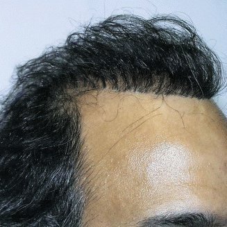 Front Hairline Repair: Dubai vs. USA Price Comparison