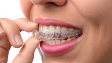 Navigating the Clear Aligners Market: Opportunities and Challenges Ahead