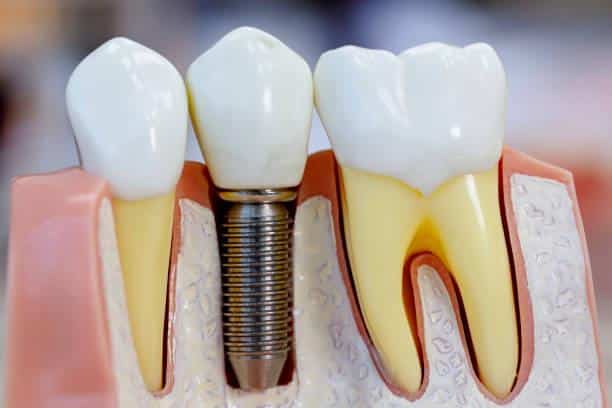 Factors to Consider Before Getting All on Four Dental Implants