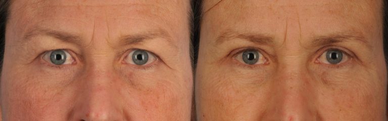 How to Maintain Your Results After Eyelid Surgery