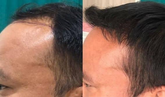 hair replacement DUBAI