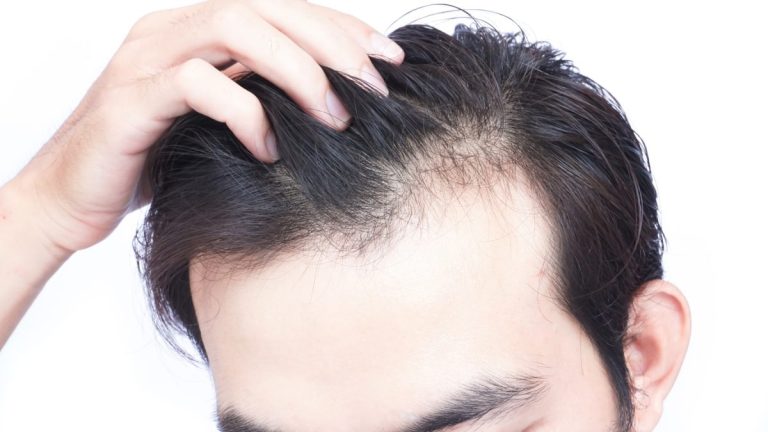 Steps to Budget for a Hair Transplant in Dubai