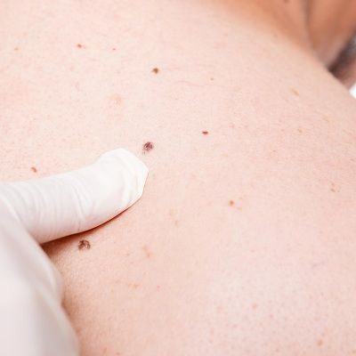 Experience Flawless Skin with Dubai’s Best Skin Tag Removal